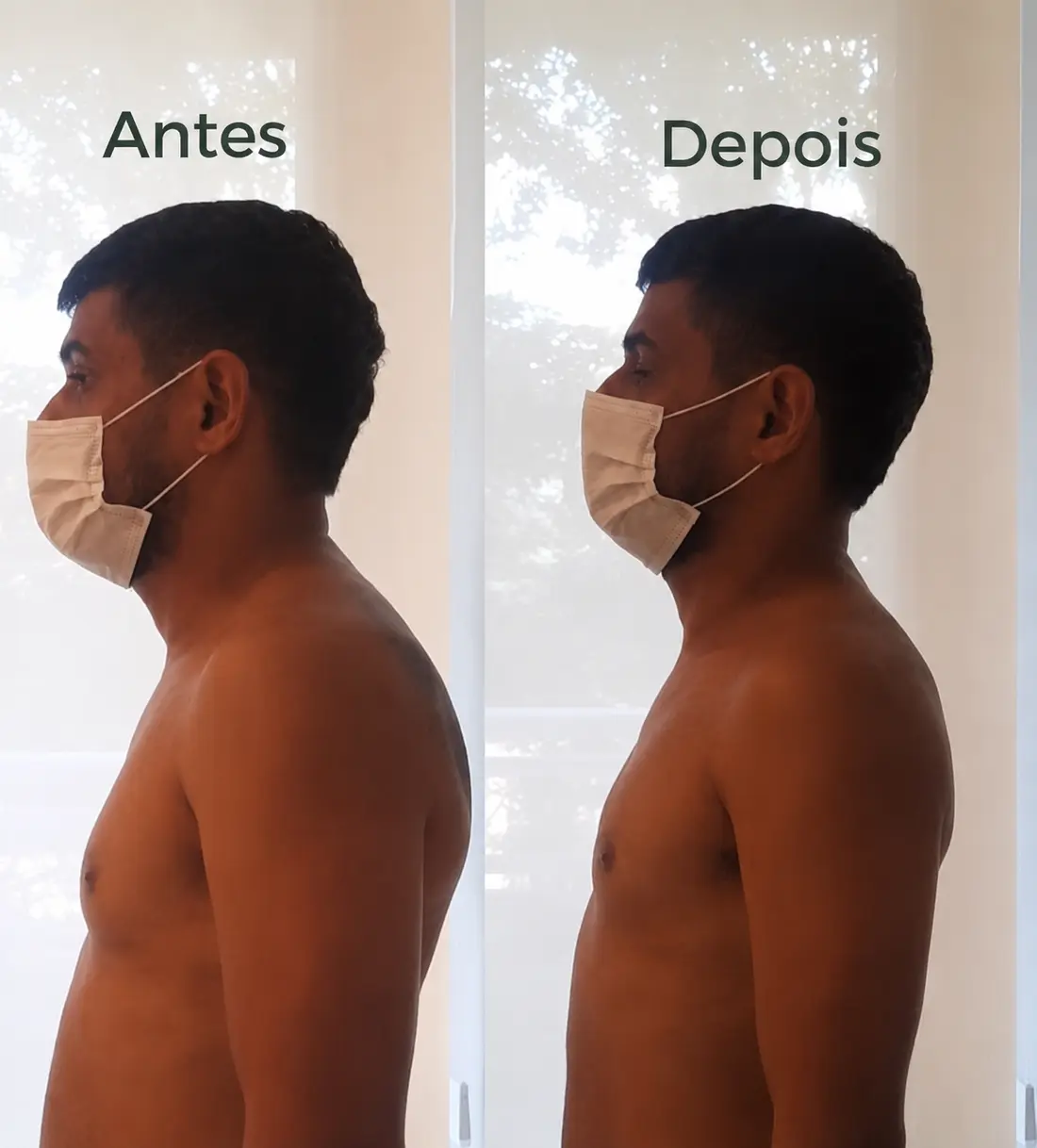 Antes e depois — alinhamento postural